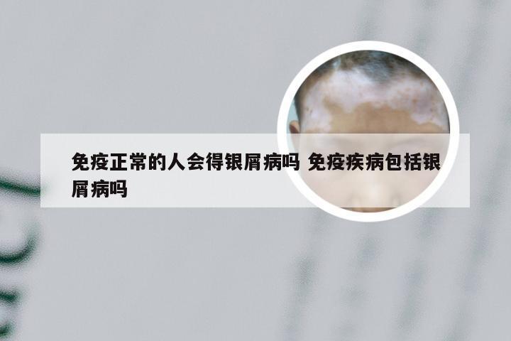 免疫正常的人会得银屑病吗 免疫疾病包括银屑病吗