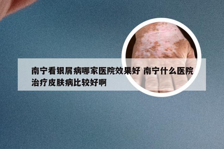 南宁看银屑病哪家医院效果好 南宁什么医院治疗皮肤病比较好啊