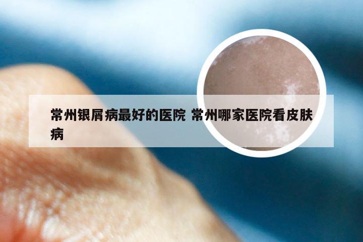 常州银屑病最好的医院 常州哪家医院看皮肤病