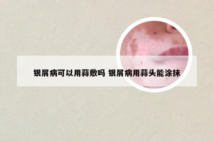 银屑病可以用蒜敷吗 银屑病用蒜头能涂抹