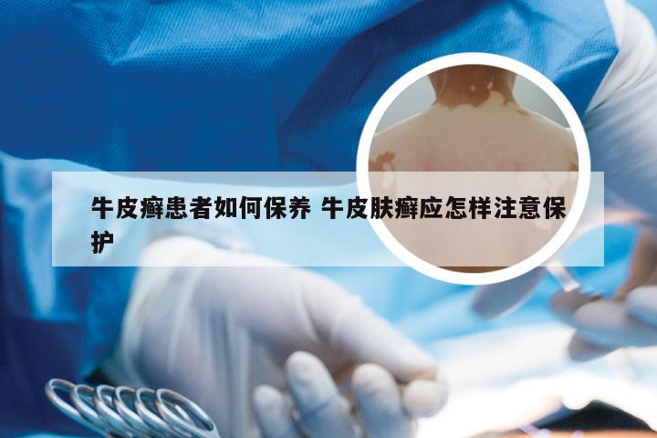 牛皮癣患者如何保养 牛皮肤癣应怎样注意保护