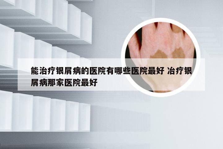 能治疗银屑病的医院有哪些医院最好 冶疗银屑病那家医院最好