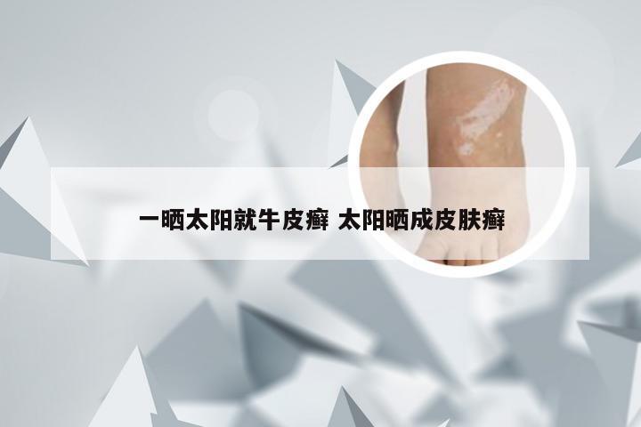 一晒太阳就牛皮癣 太阳晒成皮肤癣