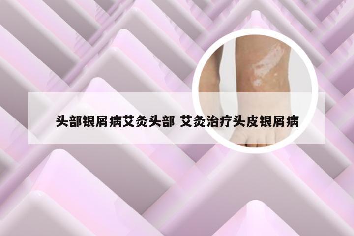 头部银屑病艾灸头部 艾灸治疗头皮银屑病