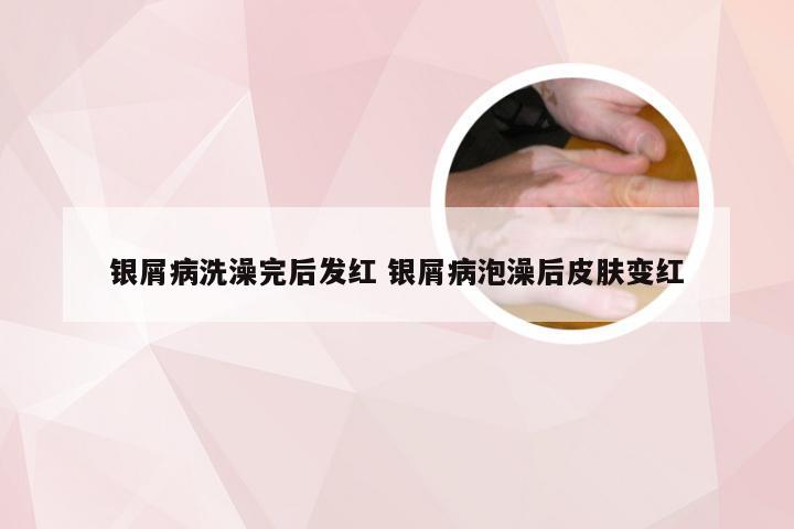 银屑病洗澡完后发红 银屑病泡澡后皮肤变红