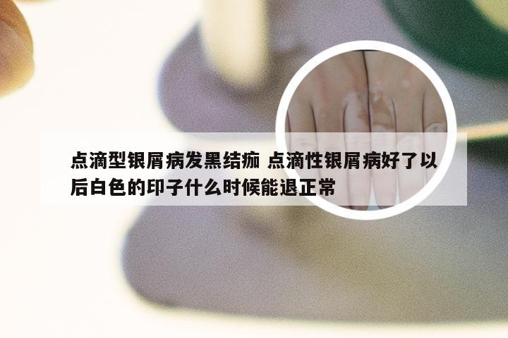 点滴型银屑病发黑结痂 点滴性银屑病好了以后白色的印子什么时候能退正常