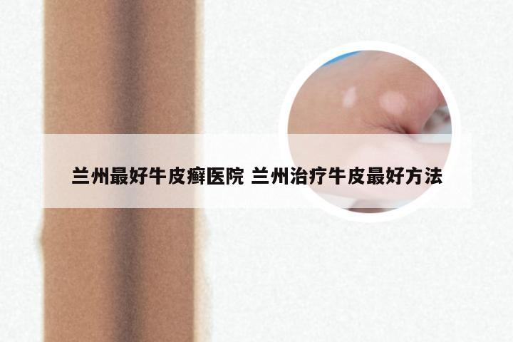 兰州最好牛皮癣医院 兰州治疗牛皮最好方法