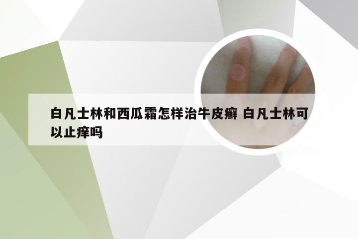 白凡士林和西瓜霜怎样治牛皮癣 白凡士林可以止痒吗