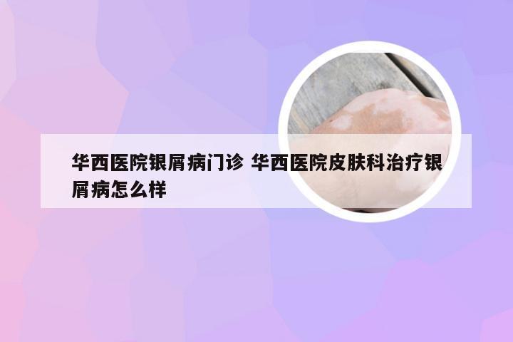 华西医院银屑病门诊 华西医院皮肤科治疗银屑病怎么样