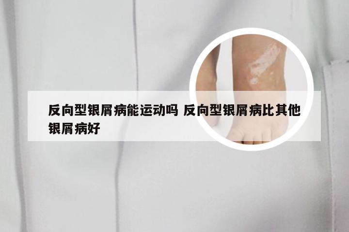 反向型银屑病能运动吗 反向型银屑病比其他银屑病好