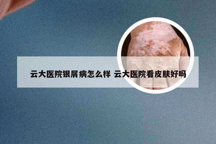 云大医院银屑病怎么样 云大医院看皮肤好吗