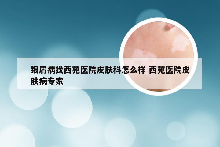 银屑病找西苑医院皮肤科怎么样 西苑医院皮肤病专家