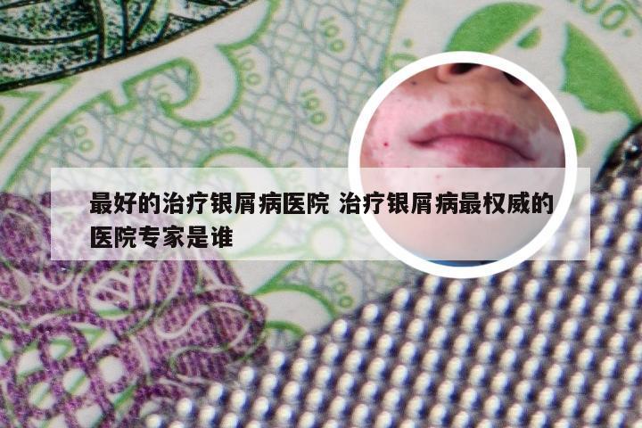 最好的治疗银屑病医院 治疗银屑病最权威的医院专家是谁