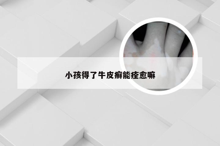 小孩得了牛皮癣能痊愈嘛