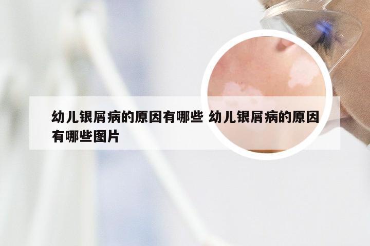 幼儿银屑病的原因有哪些 幼儿银屑病的原因有哪些图片