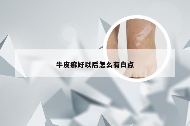 牛皮癣好以后怎么有白点