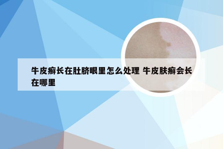 牛皮癣长在肚脐眼里怎么处理 牛皮肤癣会长在哪里