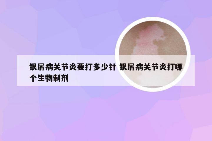 银屑病关节炎要打多少针 银屑病关节炎打哪个生物制剂