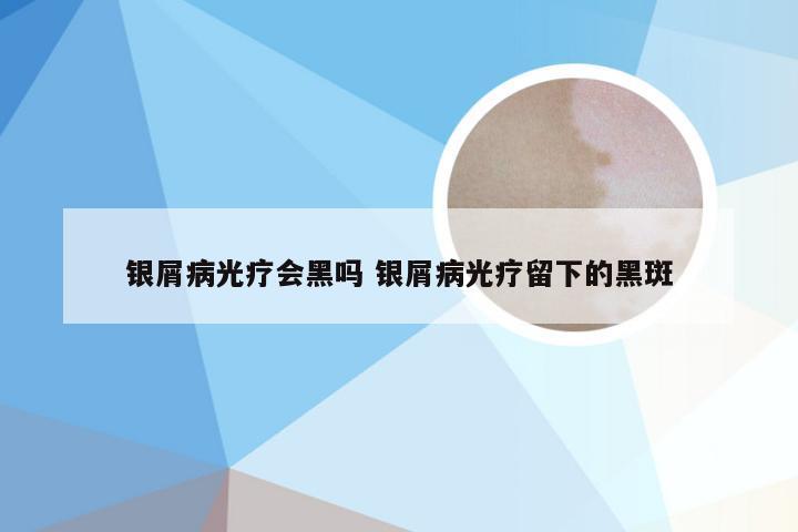 银屑病光疗会黑吗 银屑病光疗留下的黑斑