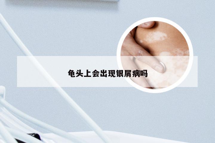龟头上会出现银屑病吗
