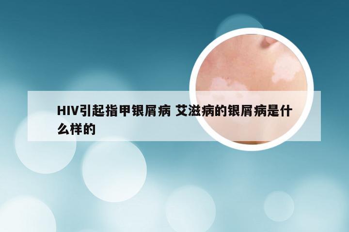HIV引起指甲银屑病 艾滋病的银屑病是什么样的