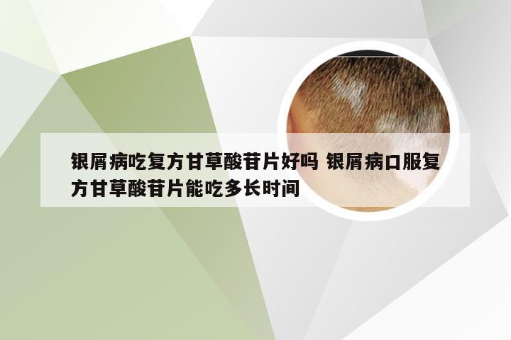 银屑病吃复方甘草酸苷片好吗 银屑病口服复方甘草酸苷片能吃多长时间