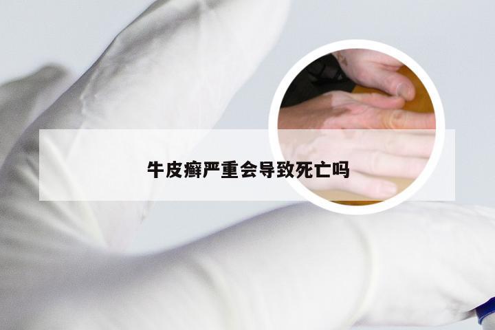 牛皮癣严重会导致死亡吗