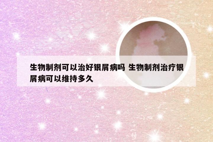 生物制剂可以治好银屑病吗 生物制剂治疗银屑病可以维持多久
