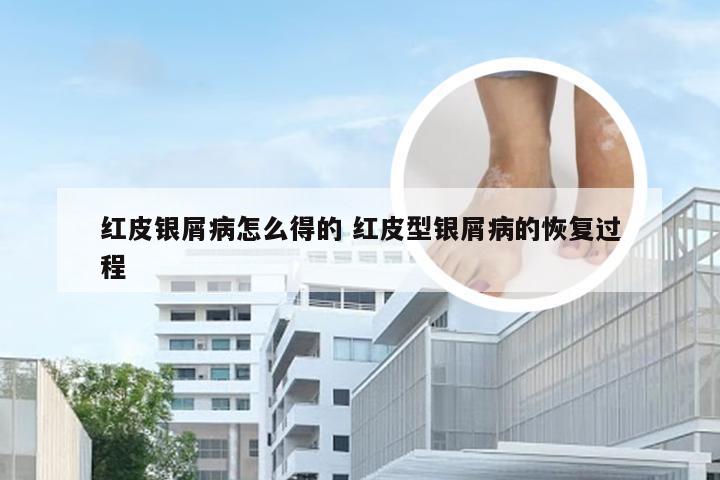 红皮银屑病怎么得的 红皮型银屑病的恢复过程