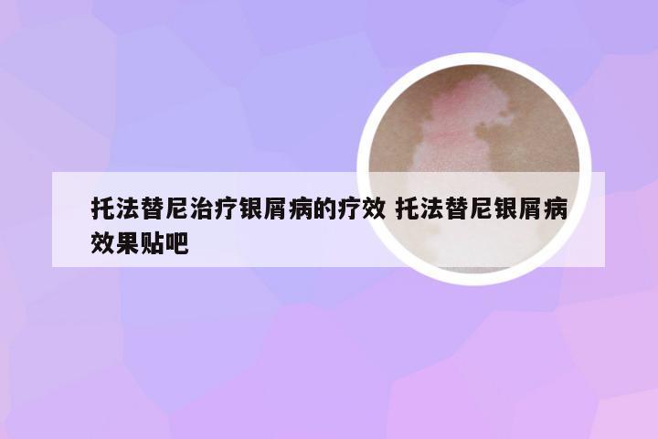 托法替尼治疗银屑病的疗效 托法替尼银屑病效果贴吧