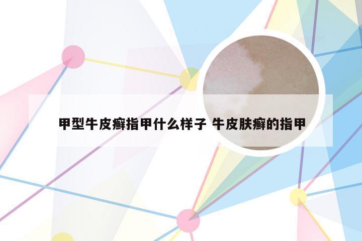 甲型牛皮癣指甲什么样子 牛皮肤癣的指甲