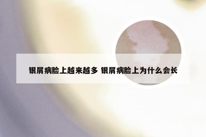 银屑病脸上越来越多 银屑病脸上为什么会长