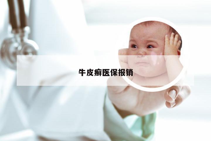 牛皮癣医保报销