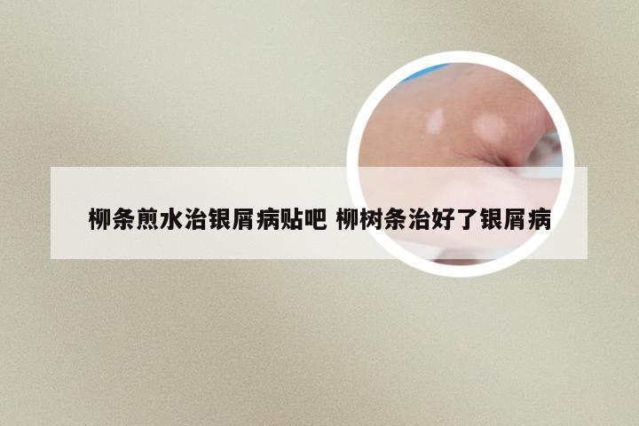 柳条煎水治银屑病贴吧 柳树条治好了银屑病