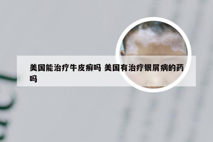 美国能治疗牛皮癣吗 美国有治疗银屑病的药吗
