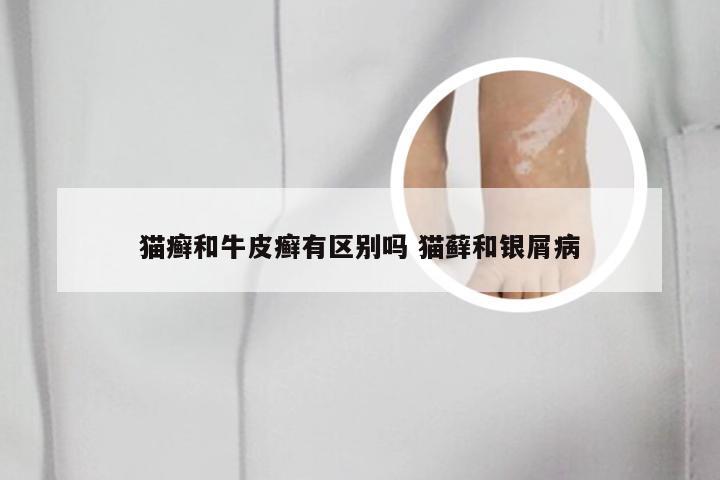 猫癣和牛皮癣有区别吗 猫藓和银屑病