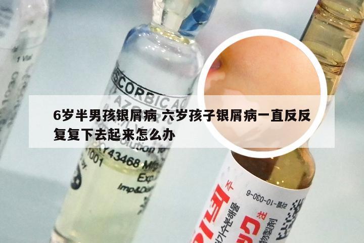 6岁半男孩银屑病 六岁孩子银屑病一直反反复复下去起来怎么办