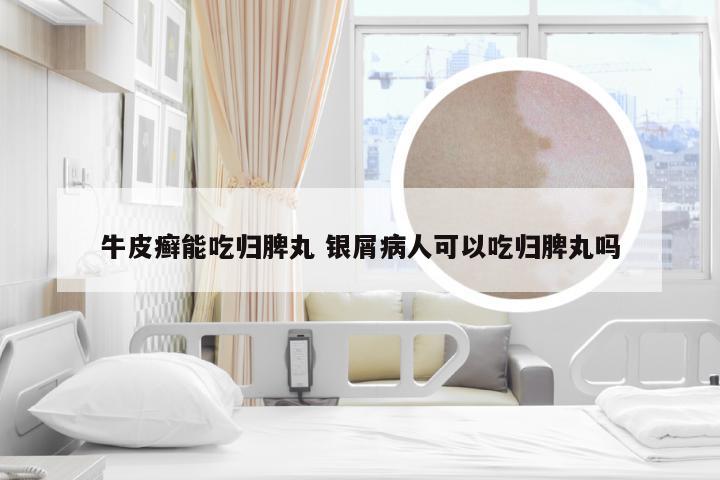牛皮癣能吃归脾丸 银屑病人可以吃归脾丸吗