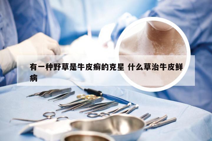 有一种野草是牛皮癣的克星 什么草治牛皮鲜病