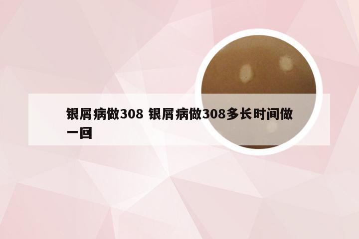 银屑病做308 银屑病做308多长时间做一回