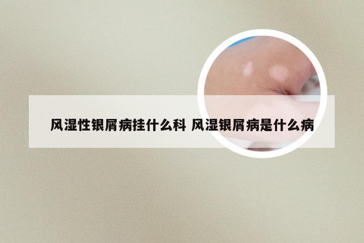 风湿性银屑病挂什么科 风湿银屑病是什么病