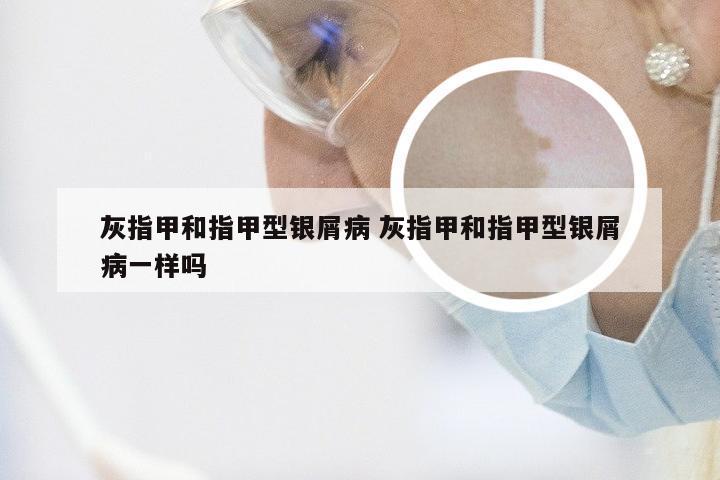 灰指甲和指甲型银屑病 灰指甲和指甲型银屑病一样吗