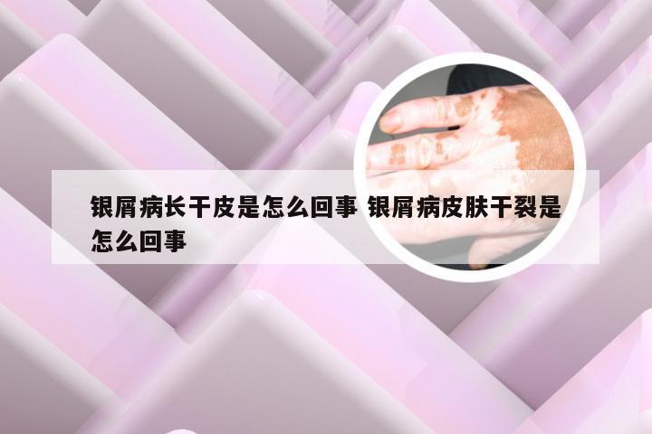 银屑病长干皮是怎么回事 银屑病皮肤干裂是怎么回事