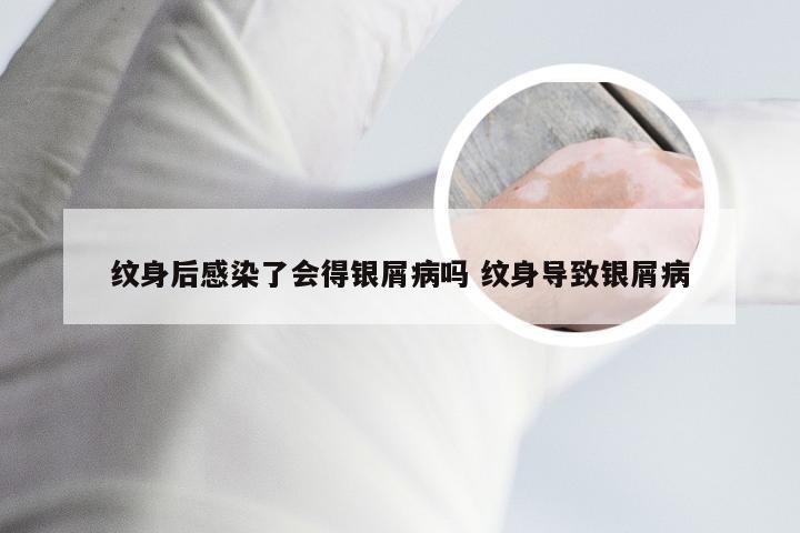 纹身后感染了会得银屑病吗 纹身导致银屑病