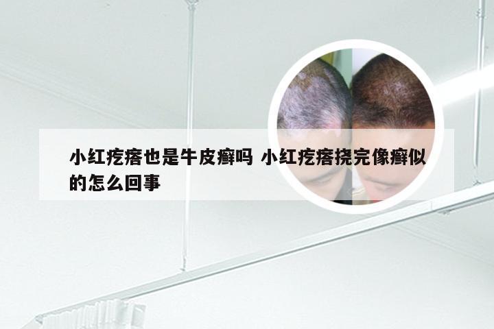 小红疙瘩也是牛皮癣吗 小红疙瘩挠完像癣似的怎么回事