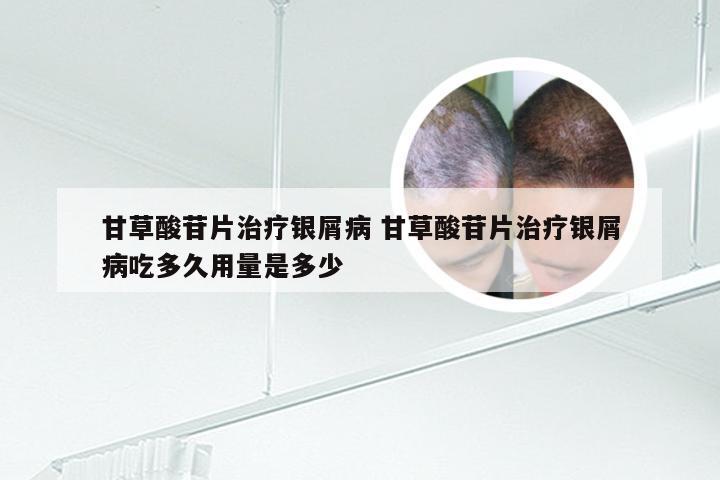 甘草酸苷片治疗银屑病 甘草酸苷片治疗银屑病吃多久用量是多少