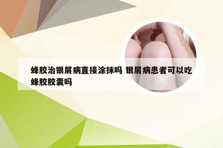 蜂胶治银屑病直接涂抹吗 银屑病患者可以吃蜂胶胶囊吗