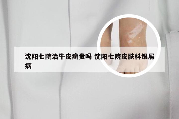 沈阳七院治牛皮癣贵吗 沈阳七院皮肤科银屑病