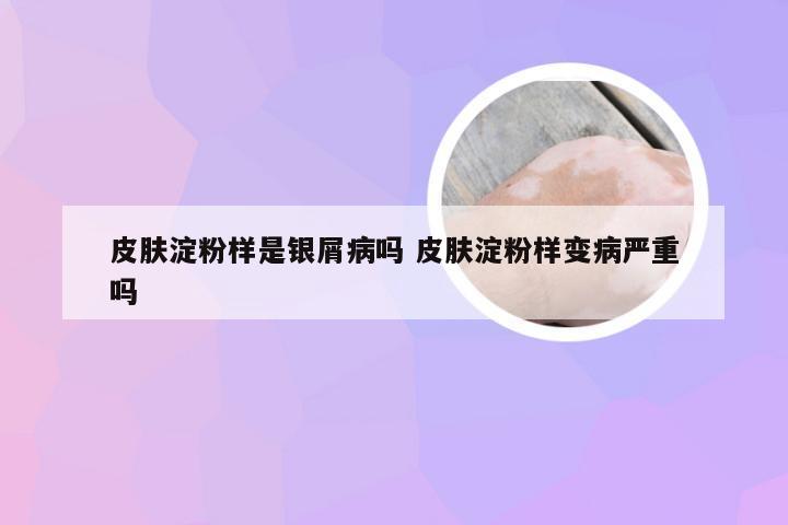 皮肤淀粉样是银屑病吗 皮肤淀粉样变病严重吗