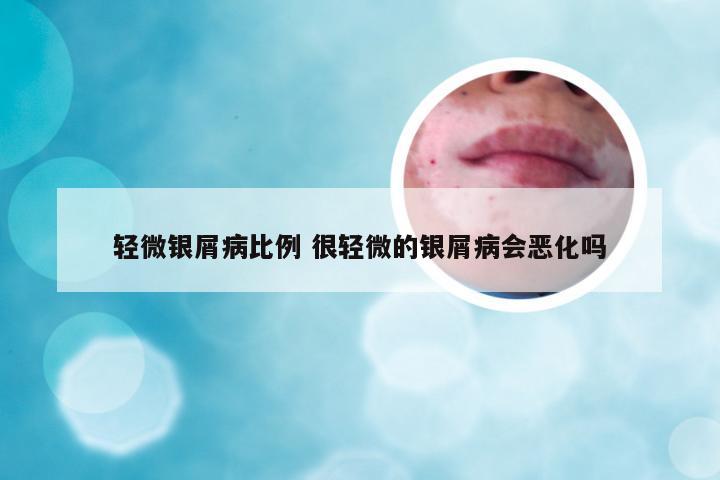 轻微银屑病比例 很轻微的银屑病会恶化吗